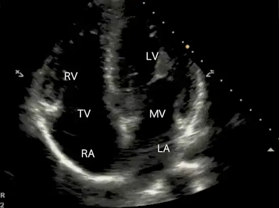 Apical Four-Chamber ultrasound frame