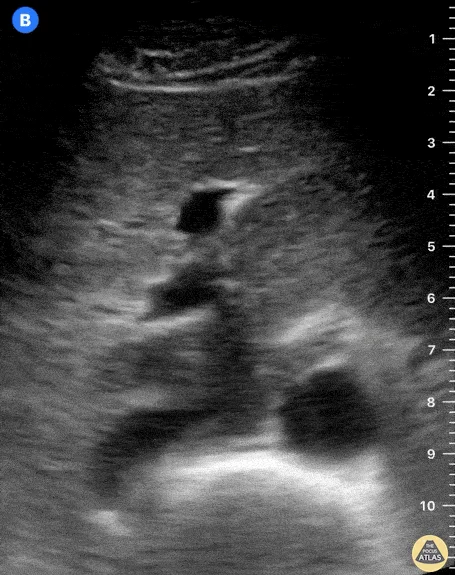 Abdominal Aorta ultrasound frame