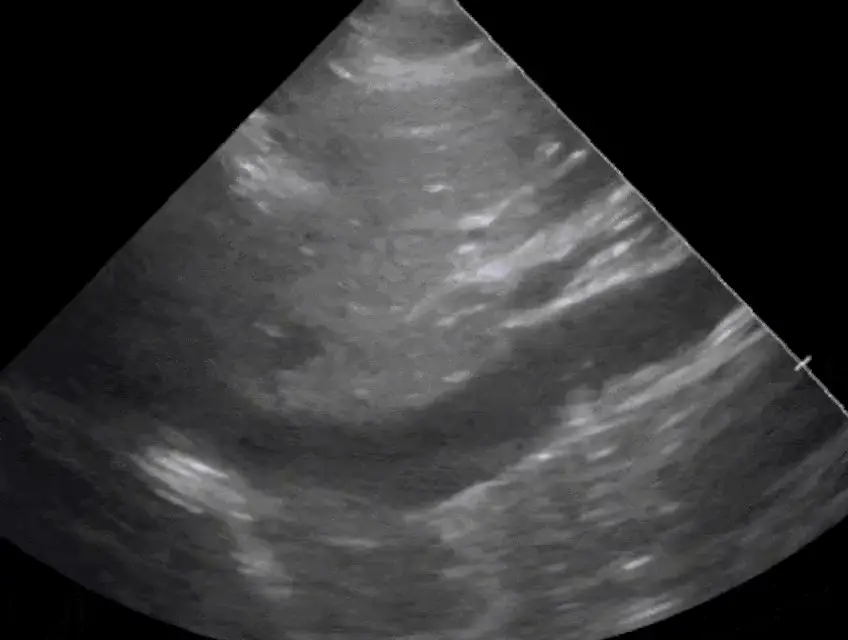 IVC and Filling Pressure ultrasound frame