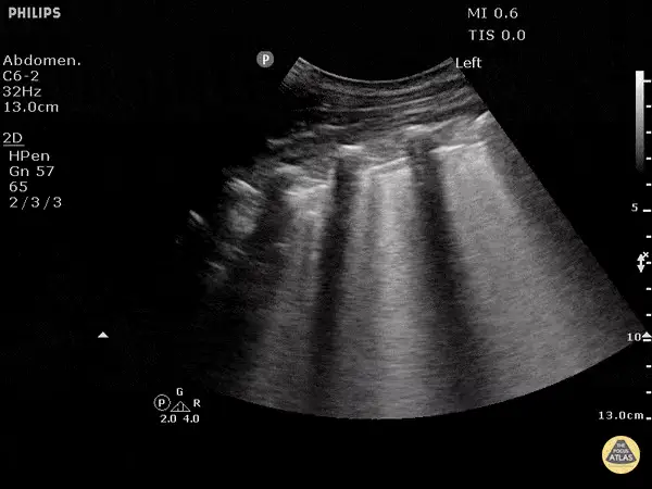 B-Lines and the Wet Lung ultrasound frame