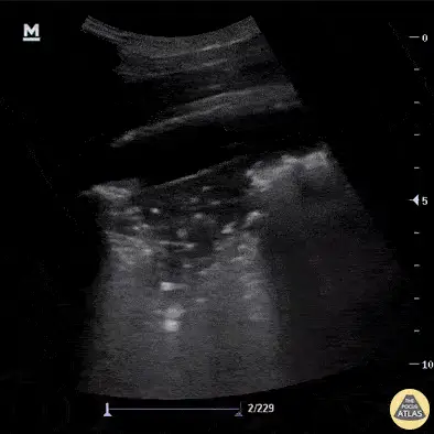 Effusion and Consolidation ultrasound frame