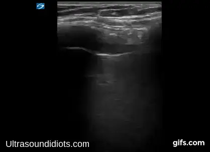 Normal Lung — A-Profile ultrasound frame