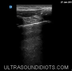 Pneumothorax ultrasound frame