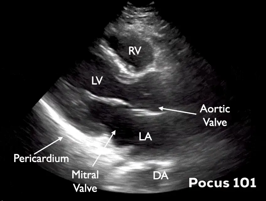 Parasternal Long Axis ultrasound frame