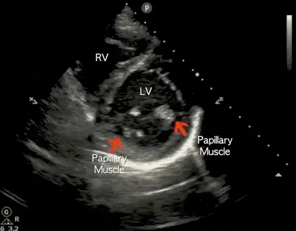 Parasternal Short Axis ultrasound frame