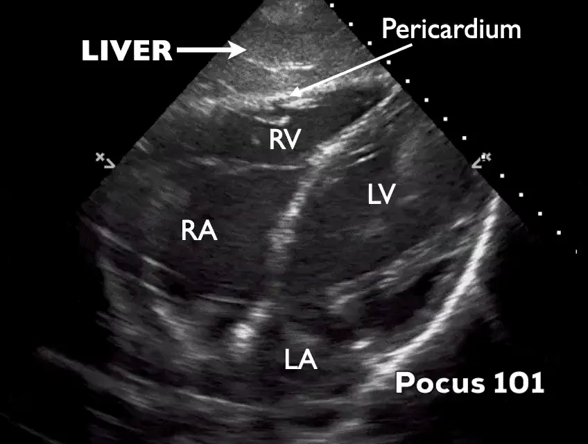 Subcostal Four-Chamber ultrasound frame