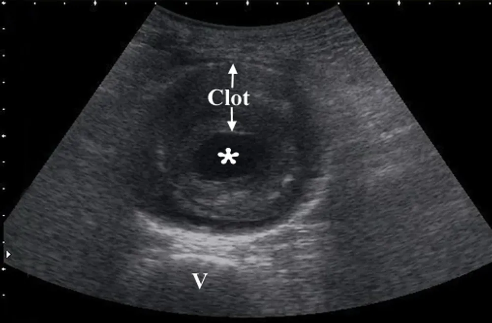 Transverse ultrasound of an abdominal aortic aneurysm with a rim of mural thrombus around a smaller patent lumen, vertebral body below