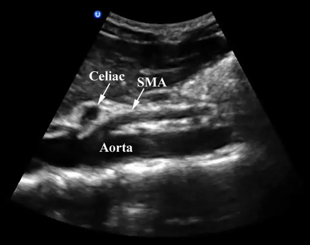 Long-axis ultrasound of the proximal abdominal aorta with the celiac trunk and superior mesenteric artery labelled